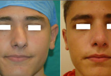 Σοβαρή απόκλιση ρινός και απόφραξη αναπνευστικής οδού