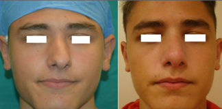 Σοβαρή απόκλιση ρινός και απόφραξη αναπνευστικής οδού