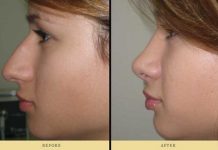 Υαλουρονικό αντί για Ρινοπλαστική, αξίζει;