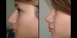 Υαλουρονικό αντί για Ρινοπλαστική, αξίζει;