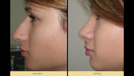 Υαλουρονικό αντί για Ρινοπλαστική, αξίζει;