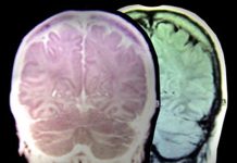Εγκεφαλικό & κληρονομικότητα: Πώς θα μειώσετε τον κίνδυνο κατά 66%
